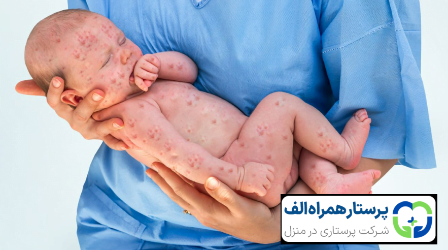 هر آنچه باید درباره آبله مرغان در کودکان بدانید 31 پرستار همراه الف