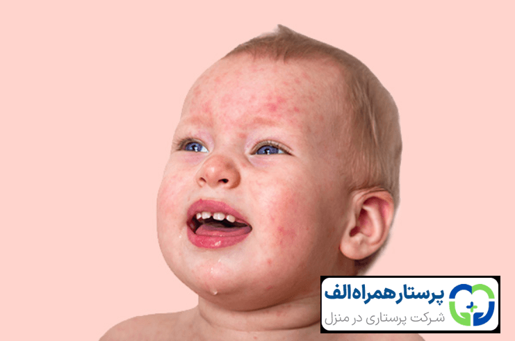 روزوئولا در کودکان چه عوارضی ایجاد می کند؟ 5 پرستار همراه الف